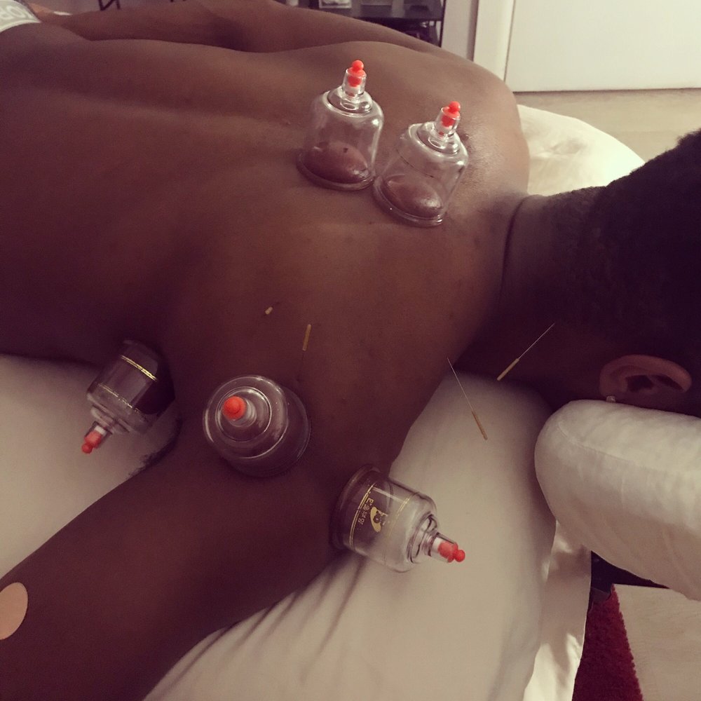 Providing Cupping Therapy In NYC